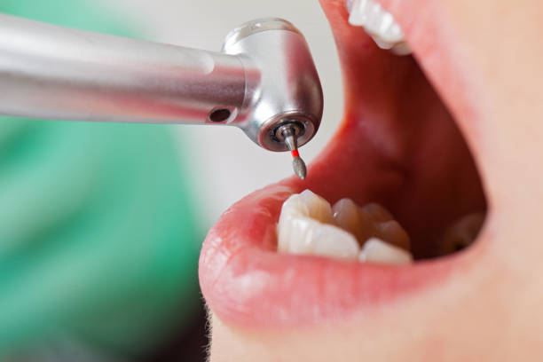 Best Knocked-Out Tooth (Avulsed Tooth) Treatment in Lyles, TN